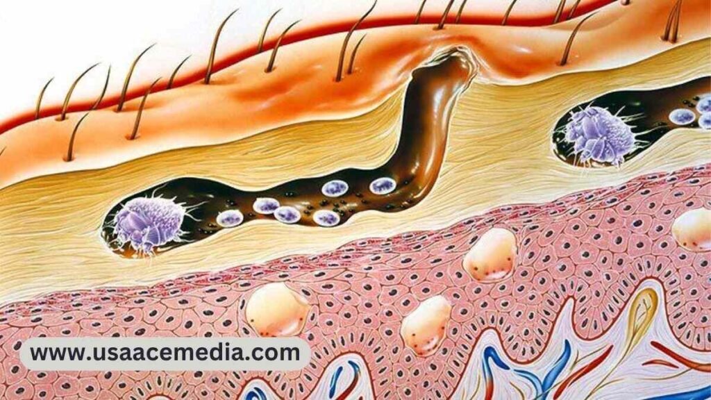 Scabies