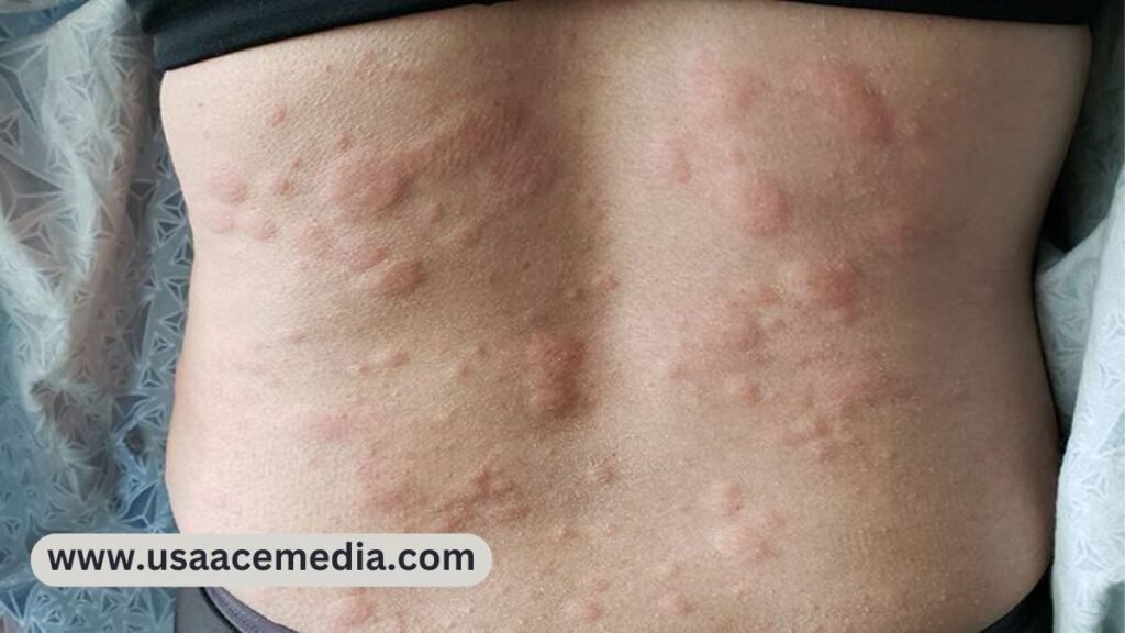 Hives