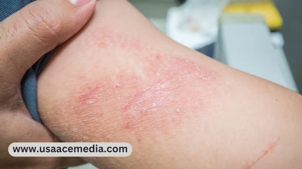 Contact Dermatitis
