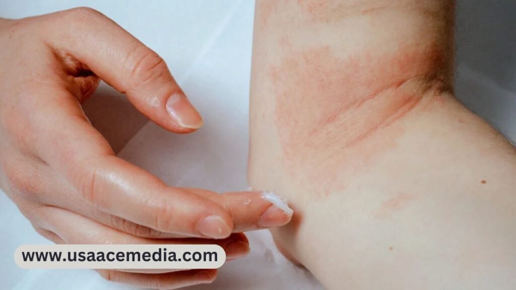 Eczema